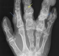 <p>What is this?</p><p>- 10-30 yo</p><p>- No pain until trauma</p>