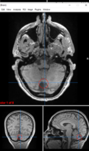 <p>cerebellum (vermis)</p>