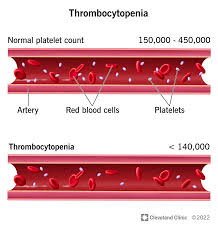 <p>What is thrombocytopenia?</p>