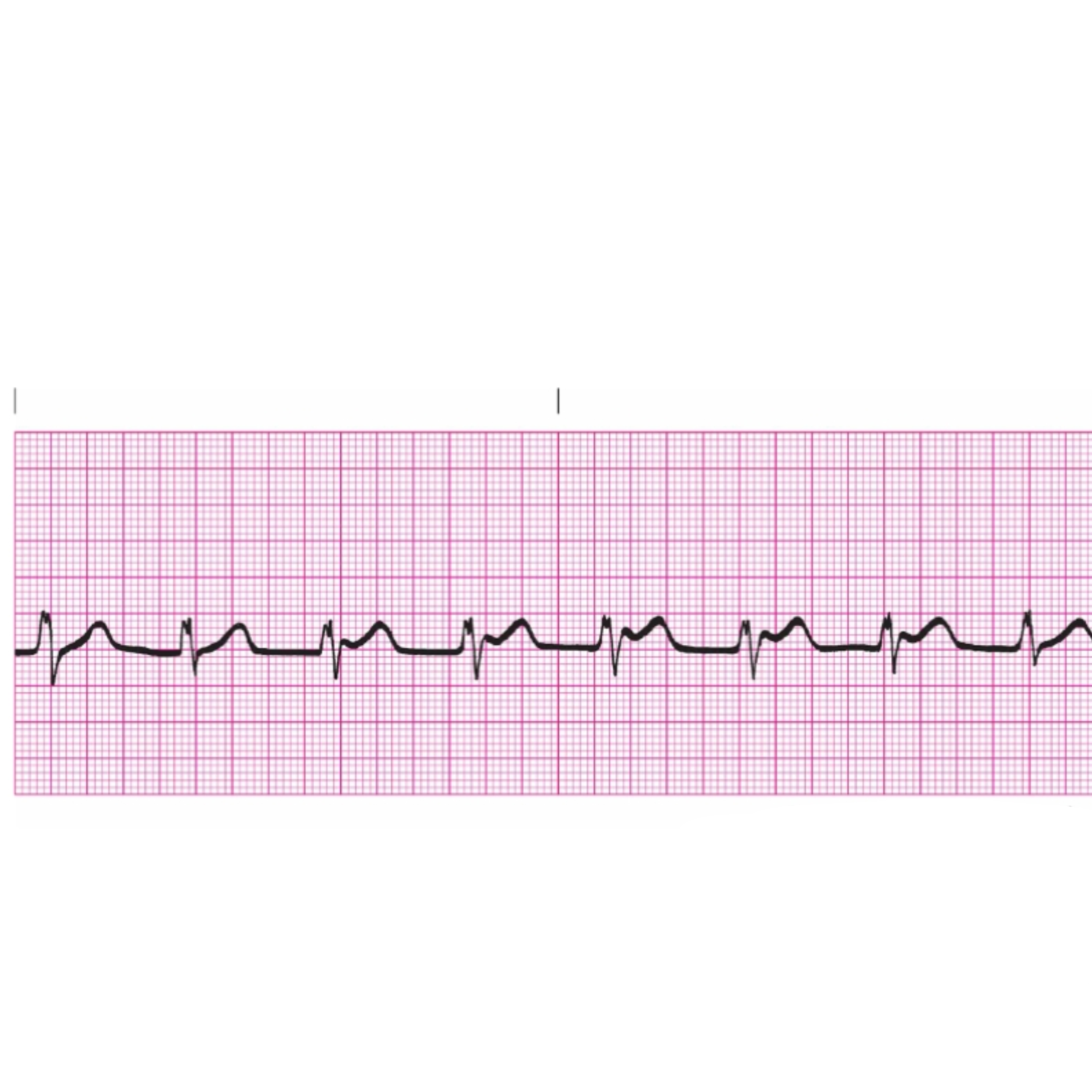 <p>Rules for Accelerated Junctional Rhythm includes </p>