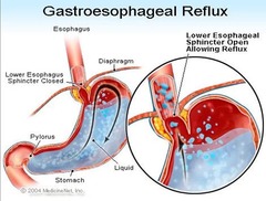 <p>Reflux of gastric contents into the esophagus.</p>