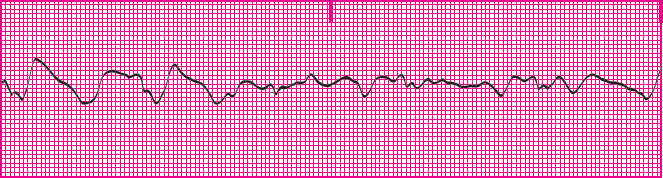 <p>Which rhythm is this?</p>