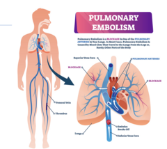 <p>blockage in one of the pulmonary arteries in your lungs. in most cases it is caused by a blood clot that travels to the lungs from the legs and rarely other places in the body</p><p>symptoms will vary on the size of the clot</p><p>- SOB, chest pain, increase heart rate, anxiety</p><p>give heparin (less serious cases) or TPA (severe cases) to dissolve clot</p><p>can put a filter in IVC to catch future clots</p>