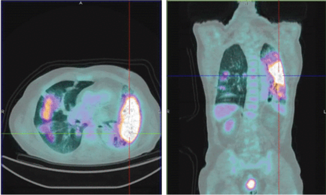 <p><span>The following PET image is indicative of:</span></p>