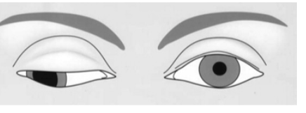 <p>results in a loss of eye movements medially or upward from the mid position </p><p>also leeds to a drooping eye lid (ptosis) and a downward lateral gaze </p>