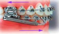 <p>what functional appliance:</p><p>◦ Spring and rod system</p><p>◦ The compressed spring applies a mesial force on the lower teeth and a distal force on the upper teeth</p><p>◦ Functional appliance</p><p>◦ Stock item</p><p>◦ Requires brackets</p>