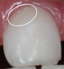 <p>What ICDAS score would be given to a tooth whose smooth surface has initial lesions seen after air drying for 5 seconds?</p>