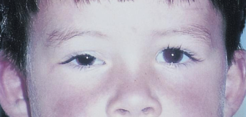 <ul><li><p>cancer of striated muscle, typically affecting the orbit of the eye</p></li></ul><p></p>