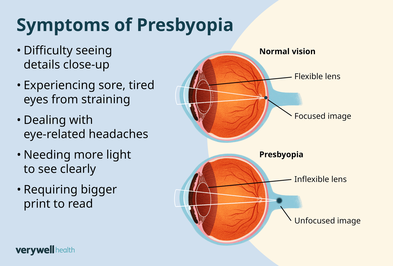 <p>PP: lens stiffens→decreased accommodation to light</p><p>E: ~40 y/o<br>age-related</p><p>CM: near→blurry vision<br>headaches<br>eye strain<br>tired eyes</p>