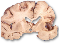 <p>What is the end stage of infarct evolution after weeks?</p>