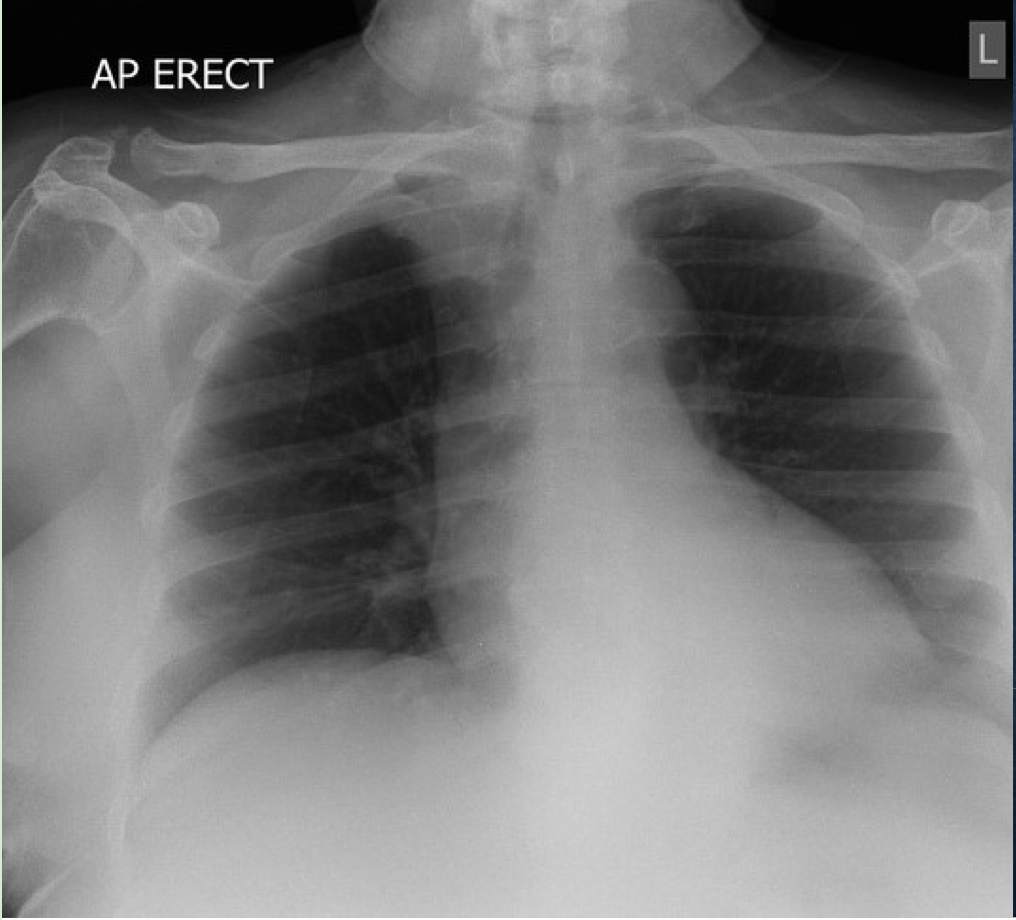 <p>Supplementary Chest view = AP Lordotic view</p>