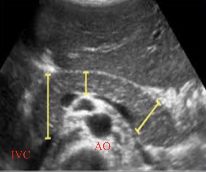 <p>Isoechoic or hyperechoic to the liver</p>