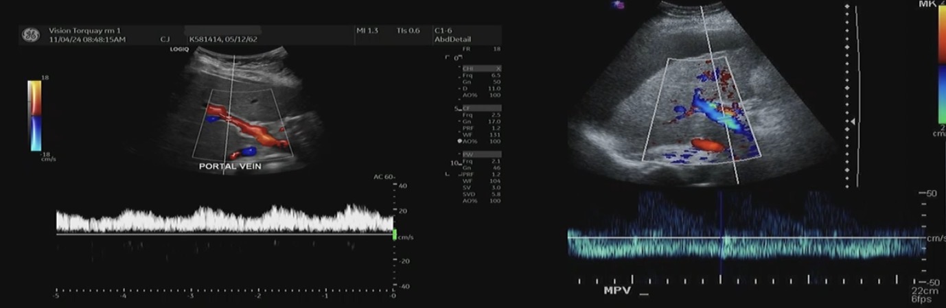 <p>Which is hepatopetal and which is heptofugal</p>