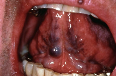 <p>not associated with other systemic diseases, most commonly observed in individuals +60 years</p>