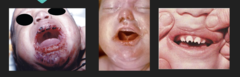 <p>- Stillbirth and death</p><p>- Maculopapular palmar/plantar rash</p><p>Early from 0-2 y/o: </p><p>- hepatosplenomegaly</p><p>- bone abnormalities</p><p>- "snuffles" (rhinitis)</p><p>- severe anemia</p><p>Late findings: </p><p>- saddle nose</p><p>- high palate arch</p><p>- Hutchinson teeth</p><p>Typical TORCH syndrome of deafness, rash, HSM, meningitis and neuro issues, fever</p>