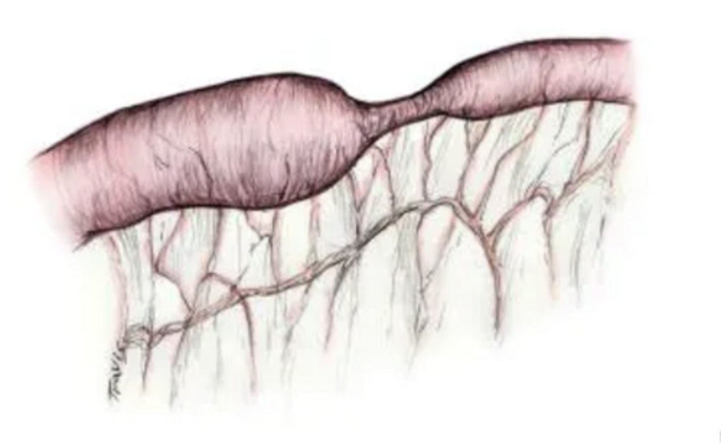 <p>narrowed or constricted passage of a body opening; vessels, ducts, bowel, esophagus, larynx</p>