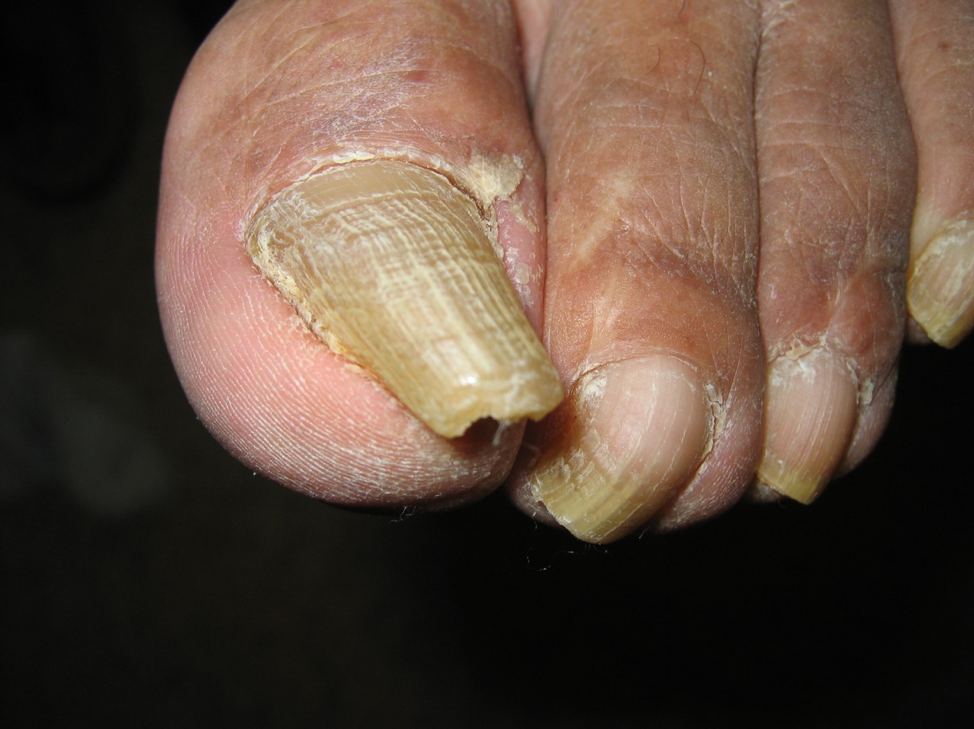 <p>what nail disorder is this?</p>