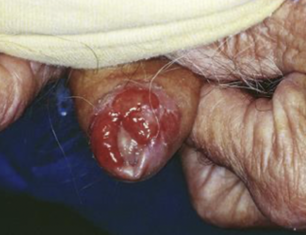 <p>carcinoma </p>