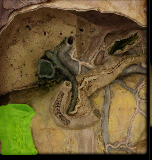 <p><span>Ascending colon</span></p>
