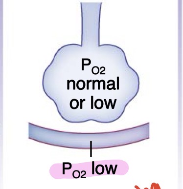 <p>Destruction of alveoli <span style="font-family: KaTeX_Main, "Times New Roman", serif; line-height: 1.2; font-size: 1.21em; color: inherit;">→</span> less surface area for gas exchange <span style="font-family: KaTeX_Main, "Times New Roman", serif; line-height: 1.2; font-size: 1.21em; color: inherit;">  →</span> low <span style="font-family: KaTeX_Main, "Times New Roman", serif; line-height: 1.2; font-size: 1.21em; color: inherit;">PO2</span></p><ul><li><p>due to smoking</p></li><li><p>damages elastic fiber</p></li><li><p>damaged, inelastic air sacs (alveoli) that trap air, making it hard to breathe</p></li></ul><p></p>
