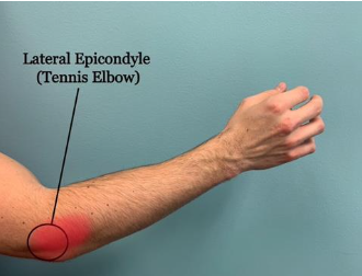 <p>Lateral Eipcondylitis (tennis elbow)</p>