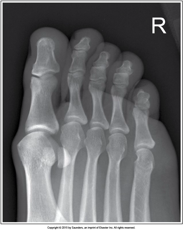 <p>AP oblique toe</p>