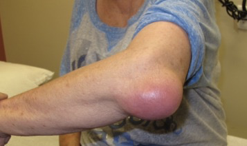 <ul><li><p>Bursa sac is such a finite space</p><ul><li><p>Etiology does matter</p></li><li><p>Sometimes do not know what happened</p></li></ul></li><li><p>Causes</p><ul><li><p>Overuse/repetitive activity (more common)</p></li><li><p>Trauma</p></li><li><p>Gout</p></li><li><p>Autoimmune</p></li><li><p>Infectious</p></li></ul></li></ul><ul><li><p>Treatment</p><ul><li><p>Conservative</p><ul><li><p>NSAIDs</p></li><li><p>Medrol pack: should not be taking NSAIDs (bleeding risk) and should be on GI protection (PPI)</p></li><li><p>Warm compresses</p></li><li><p>ACE wrap/compression</p></li><li><p>Aspiration/injection</p><ul><li><p>Use aseptic technique</p></li><li><p>Should be going parallel: collection is protruding so far out that you have so much space and have decreased risk of injecting the bone</p></li><li><p>If fluid is suspicious, then aspirate should be sent for culture, crystals, cell count, gram stain, etc… → <strong>do not inject cortisone</strong></p></li><li><p>If fluid straw colored, then cortisone can be injected to help decrease inflammation</p></li><li><p>Always clean site, Band-Aid, and <strong>ACE wrap</strong> to help compress dead space</p></li><li><p>Can re-accumulate: may need serial aspirations</p></li></ul></li></ul></li><li><p>Surgical</p><ul><li><p>Olecranon bursectomy</p><ul><li><p>May sedimentize with crystals if they have had serial injections with cortisone (> 3 times in a lifetime) → over injection has reverse effect and causes more issues </p></li></ul></li></ul></li></ul></li></ul><p></p>