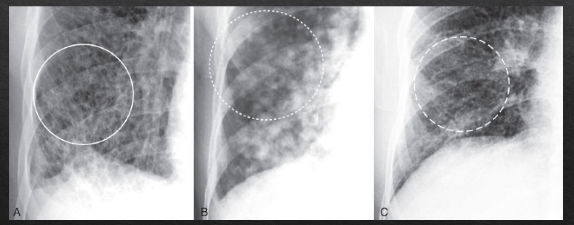 <ul><li><p><strong>criss cross pattern</strong></p></li><li><p>reticular-<strong> </strong>lines</p></li><li><p>nodular- dots</p></li><li><p>reticulonodular- lines and dots</p></li><li><p>margins- sharper and discrete</p></li></ul><p></p>