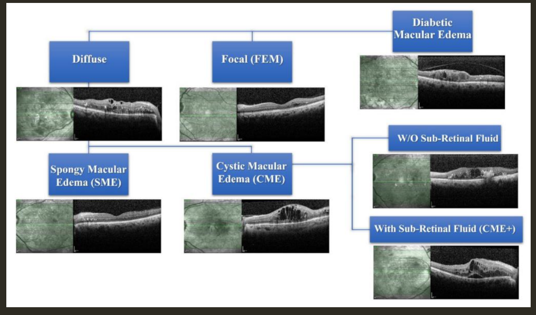 <p>CME with SRF</p>