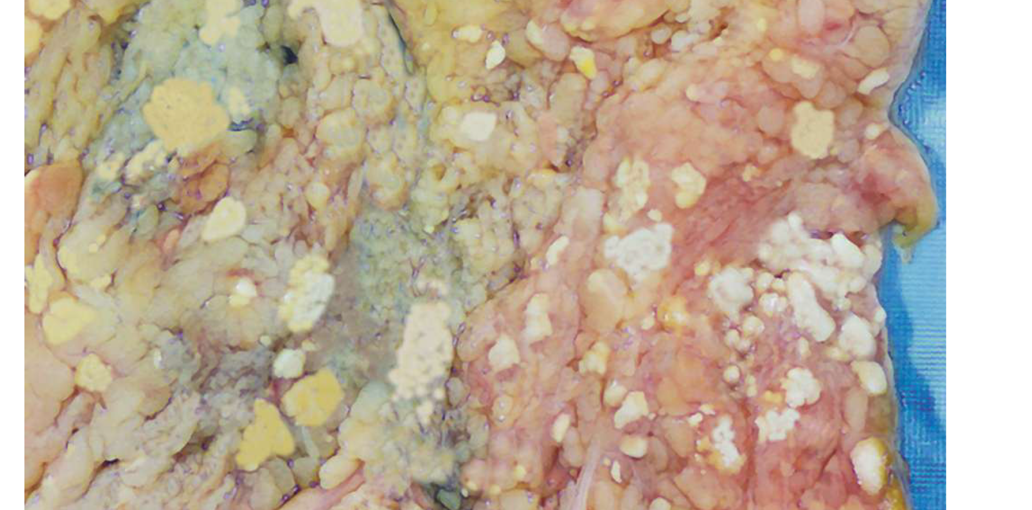 <p>chalky white deposits in fat</p>