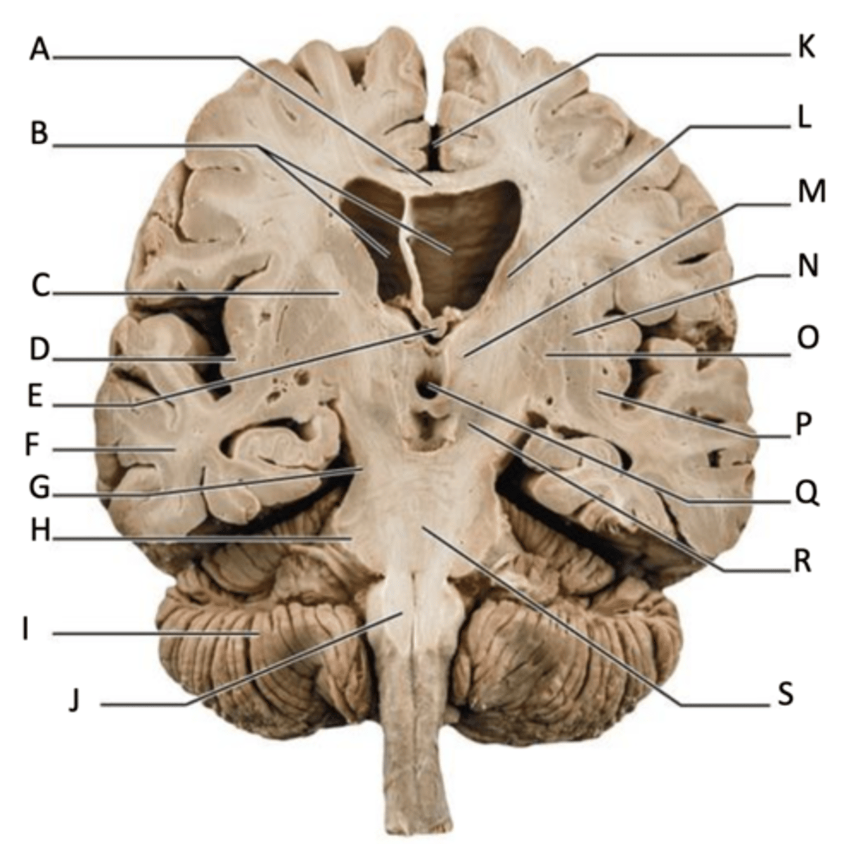 <p>lateral ventricle (b)</p>