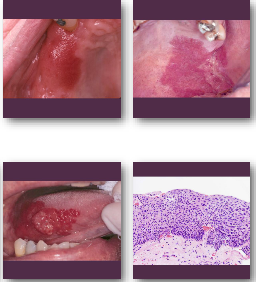 <p><strong>• Immediate biopsy required for diagnosis</strong></p><p><strong>• Often reveals severe dysplasia or carcinoma</strong></p><p>• Surgical excision usually indicated</p><p>• Close follow-up required after treatment</p><p>• <strong>High risk of malignant progression</strong></p>