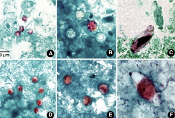 <p>Stool samples</p><p>Modified acid fas </p>