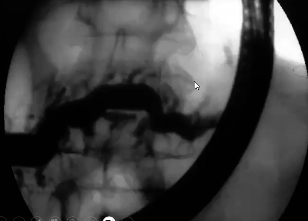 <p>abnormally dilated ducts</p>