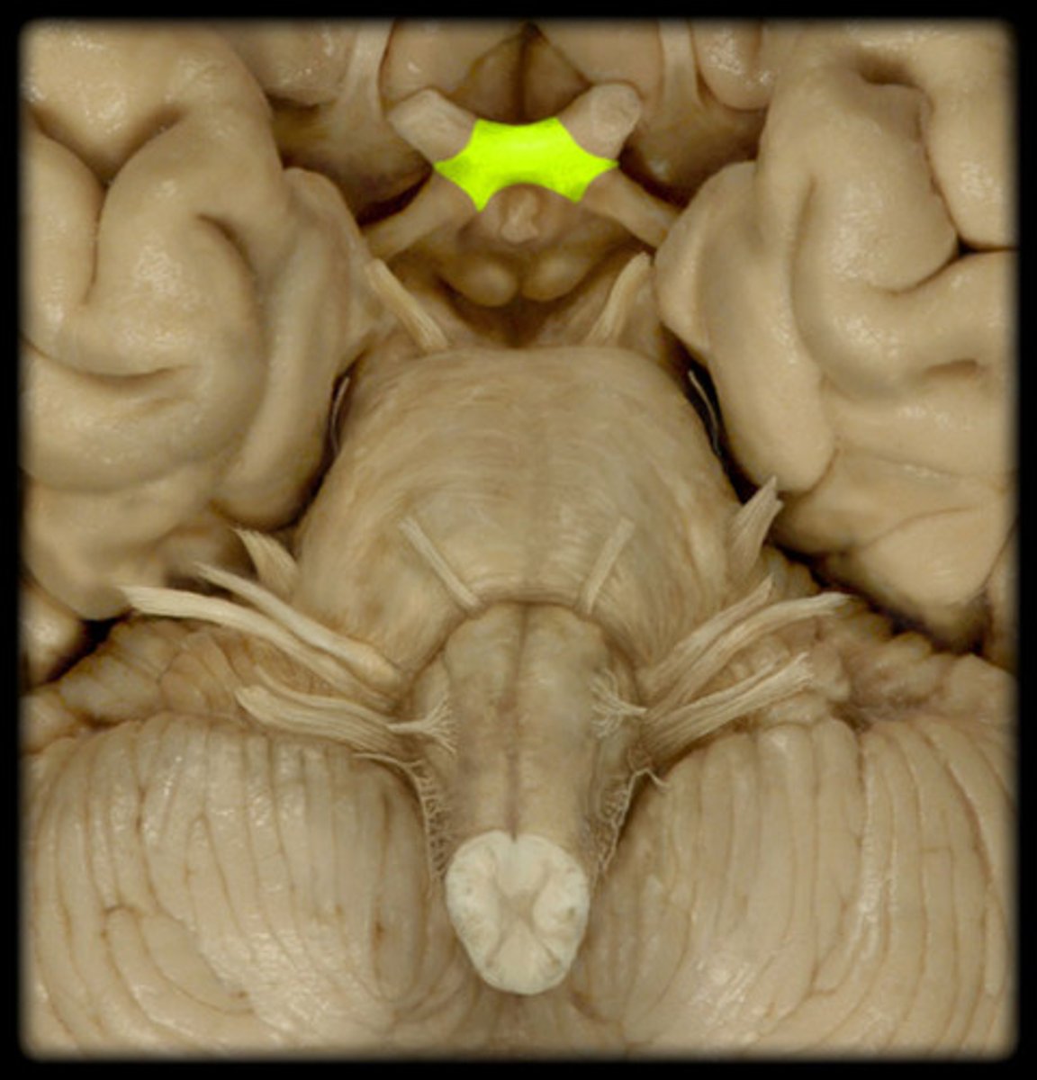 <p>Crossing of optic nerves</p>