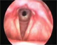 <p>Narrowing of the space <u>below the glottis and above the first tracheal ring;</u></p><p> involves narrowing of the cricoid, the only complete cartilage ring in the airway</p>