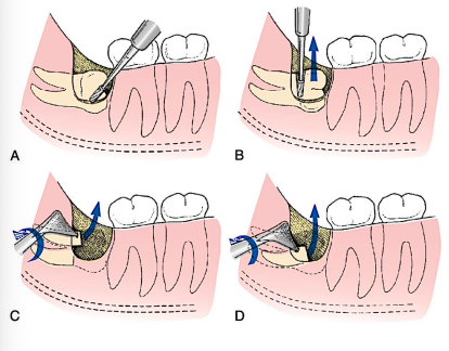 <p>remove <span style="color: red;">occlusal and buccal </span>bone to cervical line</p><p>divergent roots may require separate sectioning</p><p>section crown from roots; remove crown, elevate roots with <span style="color: red;">cryer elevator</span></p>