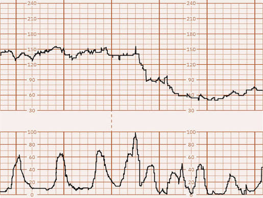 <p>If a baby HR drops suddenly BUT stays low for 2 min & longer than it becomes….</p>