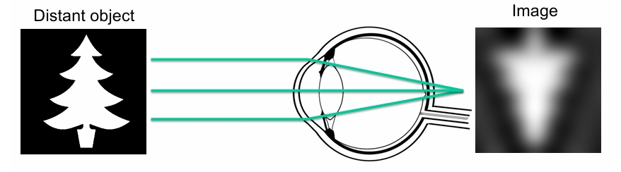 <p>Long sightedness </p><p>• The hyperopic eye has too little focal power for its length </p><p>• Light rays converge (are focused) behind the retina. </p><p>• The image at the retina is blurred (out of focus) Image . </p><p>• Remember that close objects are focused further to the lens - A hyperopic eye will not be able to focus on close objects, but can focus on objects at a long distance.</p>