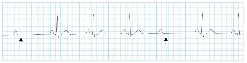 <p>What kind of heart block is this?</p>