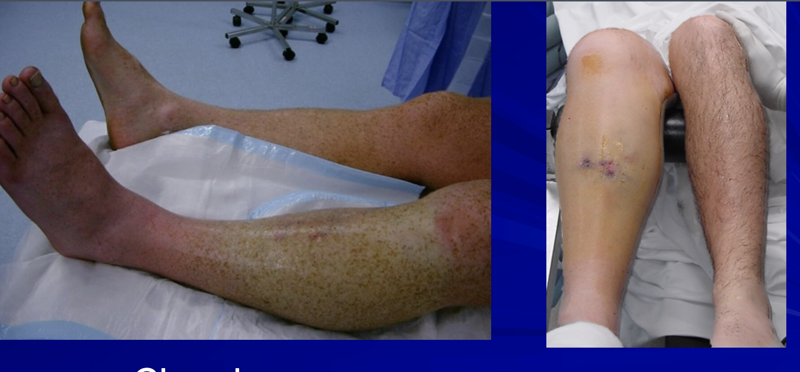 <p>What is compartment syndrome? MOI for acute and chronic? The 6 P’s</p>