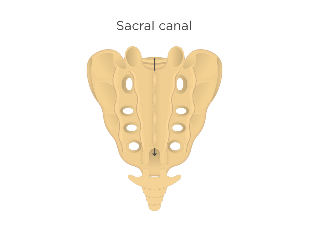 <p>sacral canal</p>