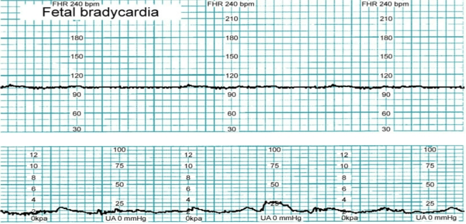 <p>complications or causes for feal bradycardia</p>