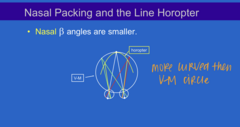 <p>When there is nasal packing, the ____ angles on the nasal retina is smaller</p>