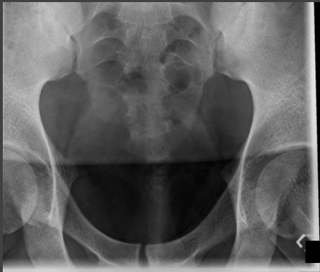<p>critique coccyx AP axial </p>
