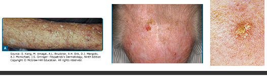 <p>Describe Actinic keratosis and It’s histology</p>
