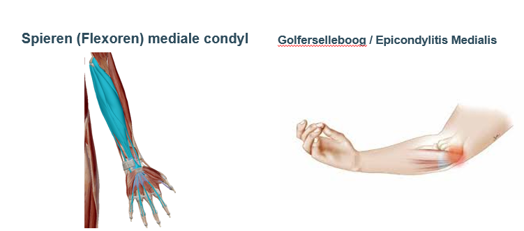 <p><span>Meeste van deze spieren starten aan mediale humerus epicondyl.</span></p><p style="text-align: left;"></p><p style="text-align: left;"><span>Bij overbelasting (repetitieve flexor beweging), kan er een overbelasting gebeuren thv hun oorpsrong/</span></p><p style="text-align: left;"><span>= golvers elleboog</span></p><p style="text-align: left;"></p><p style="text-align: left;"><span>Epicondylitis medialis = ontsteking van de peesgroep thv de <strong>mediale </strong>epicondyl (het zijn de voorarm en polsflexoren).</span></p>
