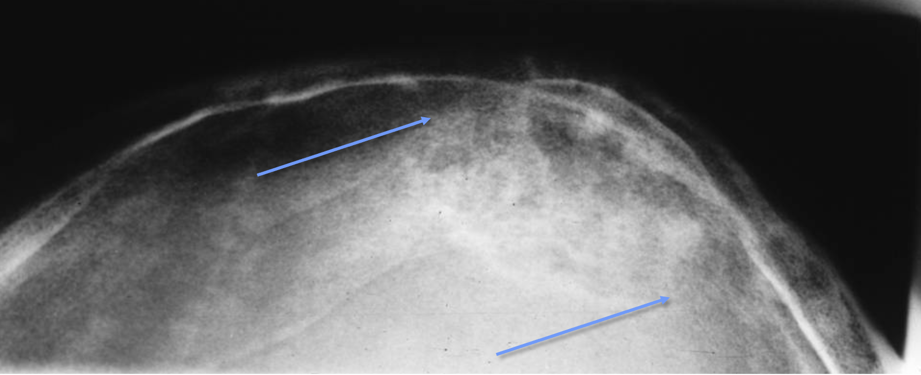 <p>What tumour like disorder is this?</p>