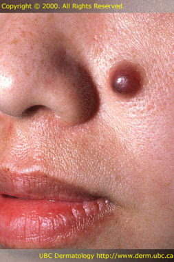 <p>Solid, elevated (fatty lipoma)<br>1 cm</p>