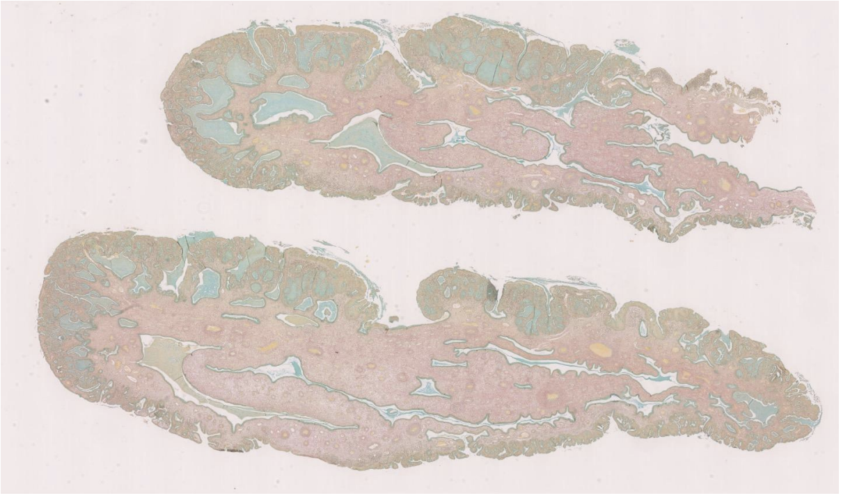 <p>Endocervical Polyp: Alcian blue stain</p>